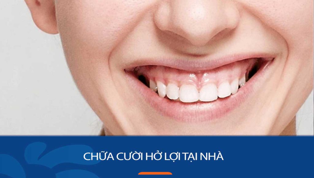 8 Cách chữa cười hở lợi tại nhà Trong Vòng 7 Ngày