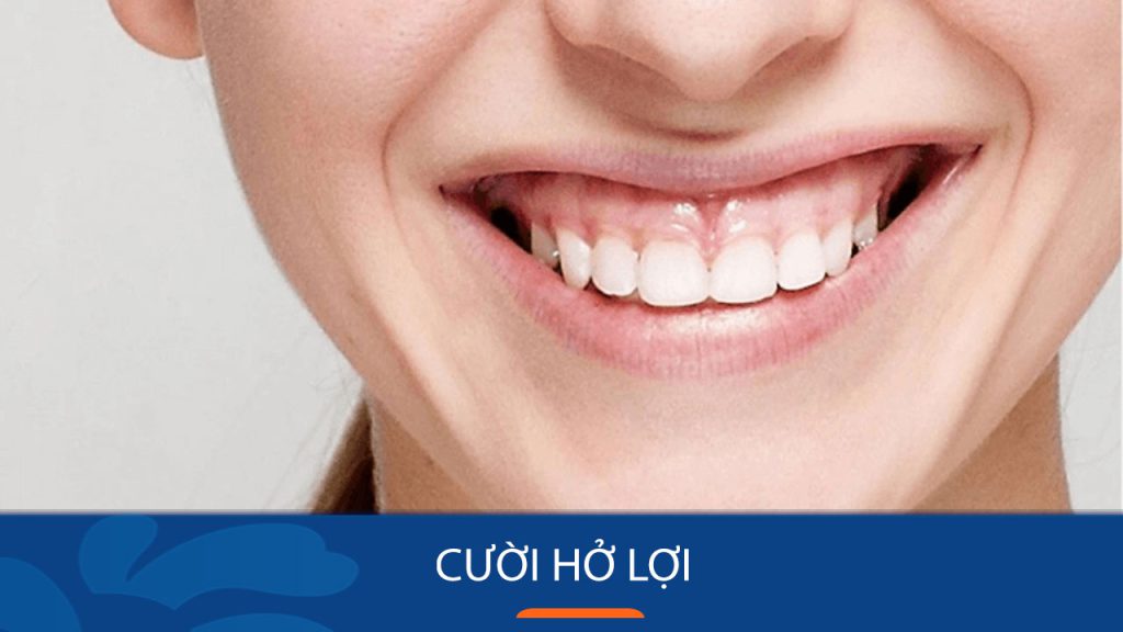 Cười hở lợi: Tướng số Nam, Nữ và ảnh hưởng tới sức khỏe