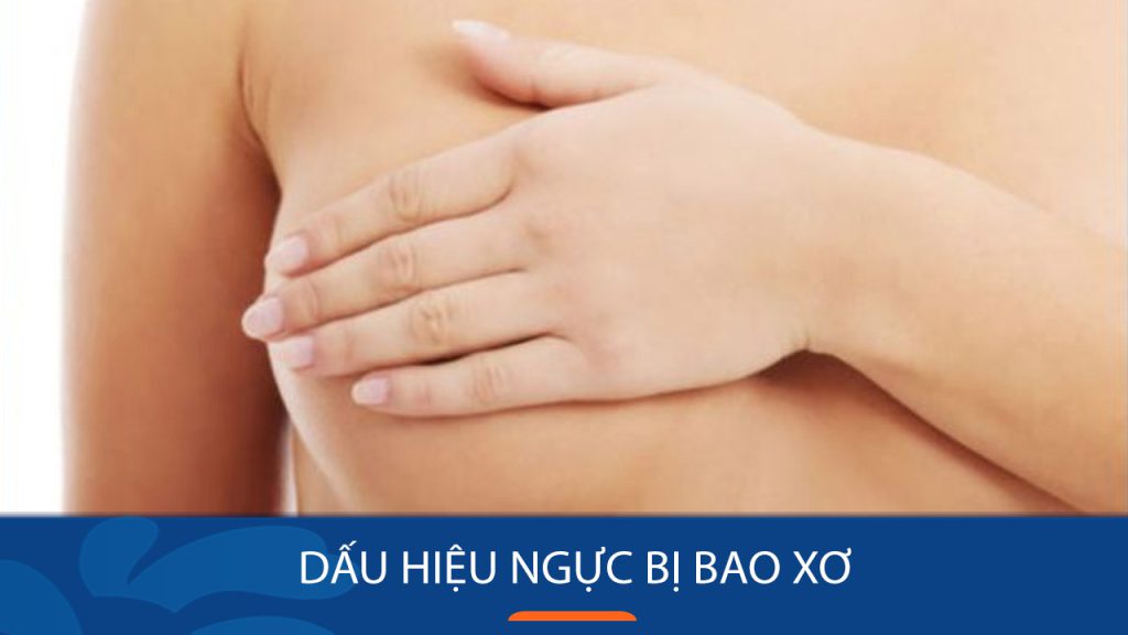 Cảnh báo bao xơ ngực sau nâng ngực: Biến chứng nguy hiểm và cách bảo vệ bạn