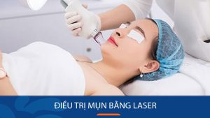 Điều trị mụn tận gốc bằng laser – Nhanh chóng – Hiệu quả