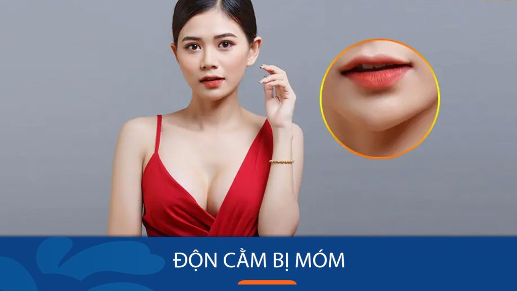 Độn cằm bị móm: Loại bỏ hoàn toàn, lấy lại nhan sắc!