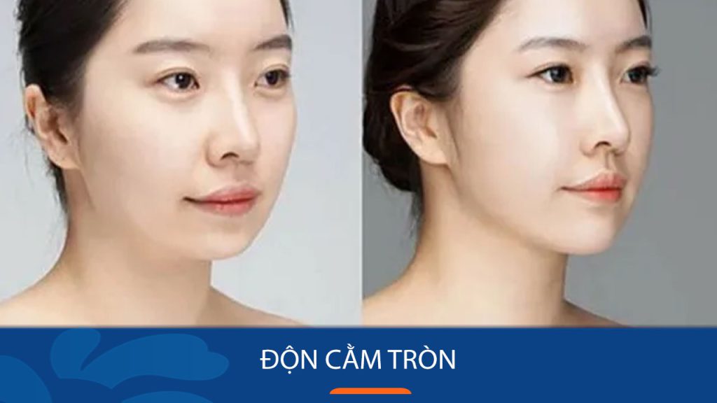 Độn cằm tròn đẹp tự nhiên – Giải pháp hoàn hảo cho khuôn mặt hài hòa