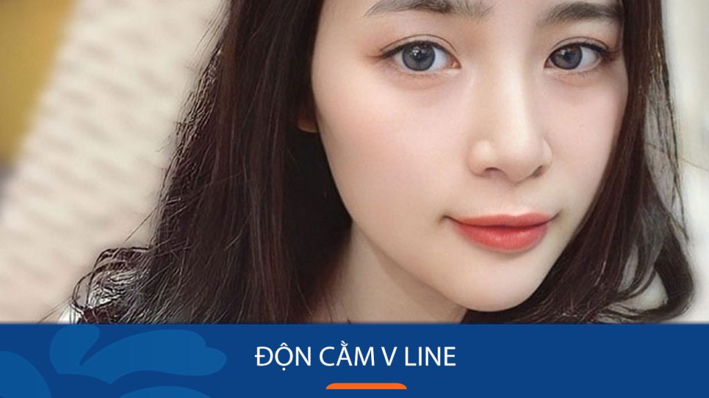 Phẫu thuật độn cằm V line: giá bao nhiêu và có vĩnh viễn không