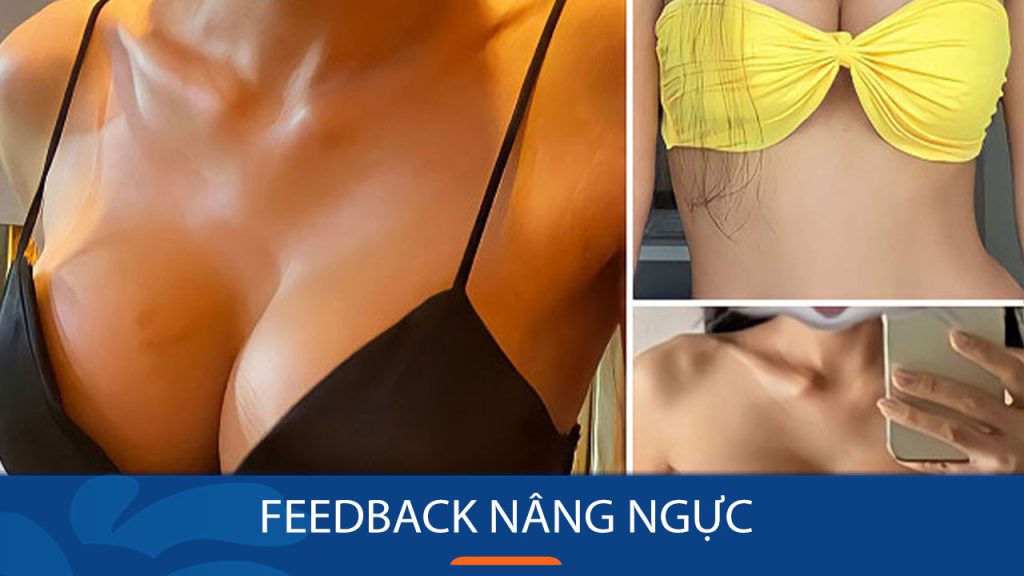 Feedback nâng ngực: Những đánh giá thực tế về phẫu thuật nâng ngực