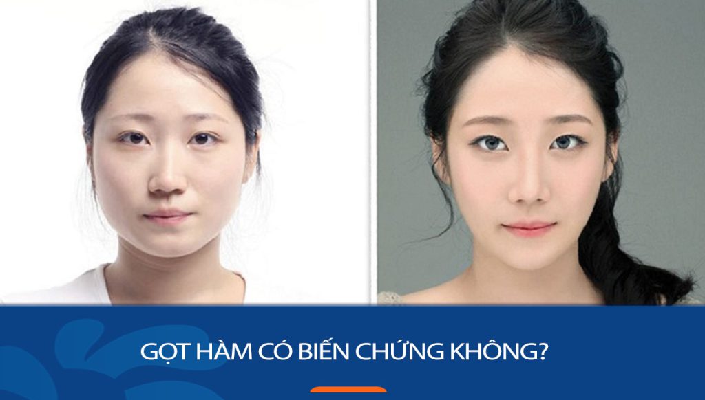 Gọt hàm có nguy cơ phát sinh biến chứng không?