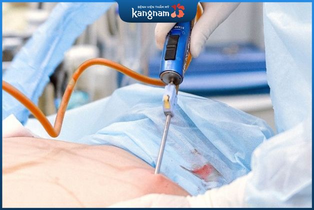 Hút mỡ bụng giúp tạo hình vòng 2 gọn gàng