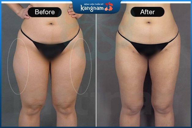Hút mỡ vùng đùi phía ngoài, làm giảm kích thước chân