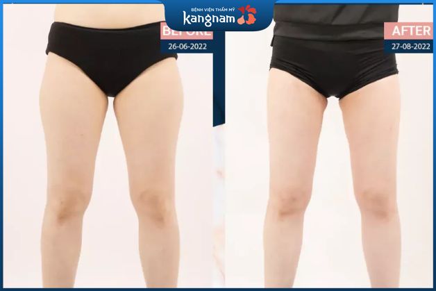 Sở hữu bắp đùi thon gọn, săn chắc và giảm chảy xệ