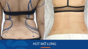 Hút mỡ lưng – Sở hữu ‘thắt đáy lưng ong’ chỉ sau 90 phút