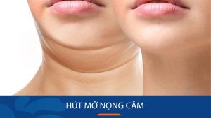 Hút mỡ nọng cằm – Loại bỏ 90% mỡ, giúp gương mặt thanh thoát