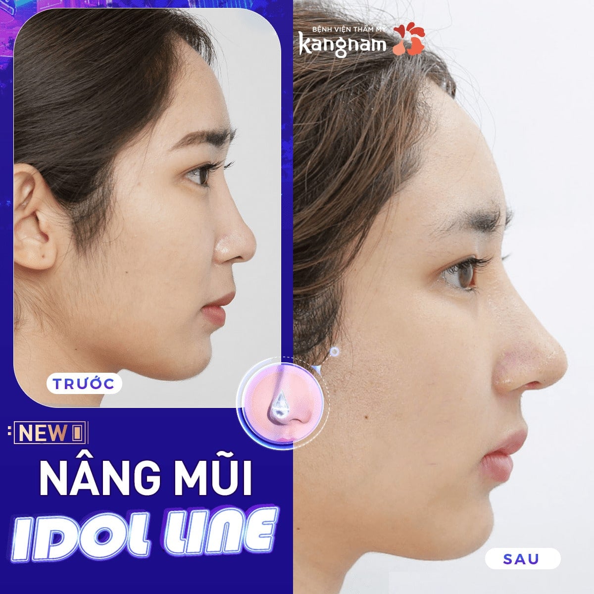 Nâng mũi Idol Line chuẩn theo Idol xứ Hàn