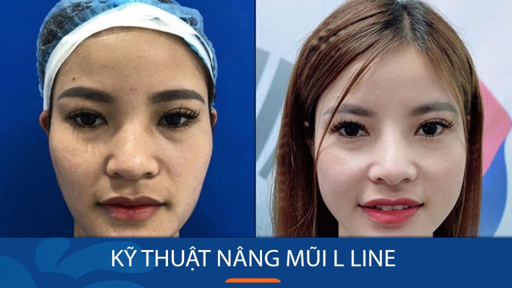 Nâng mũi L Line: Bí quyết sở hữu dáng mũi hoàn hảo – Bệnh viện kangnam
