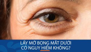 Lấy mỡ bọng mắt dưới có nguy hiểm? – lưu ý quan trọng