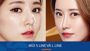 S Line và L Line: Những kiểu dáng mũi phổ biến trong phẫu thuật thẩm mỹ