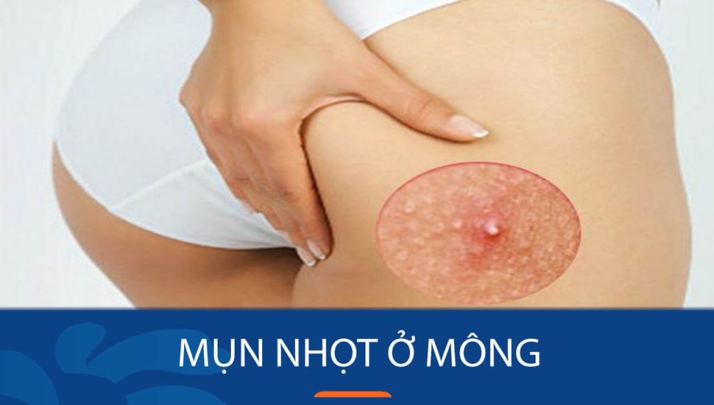 Mụn nhọt ở mông: 12 Cách Chữa Trị Hiệu Quả Nhất 2024