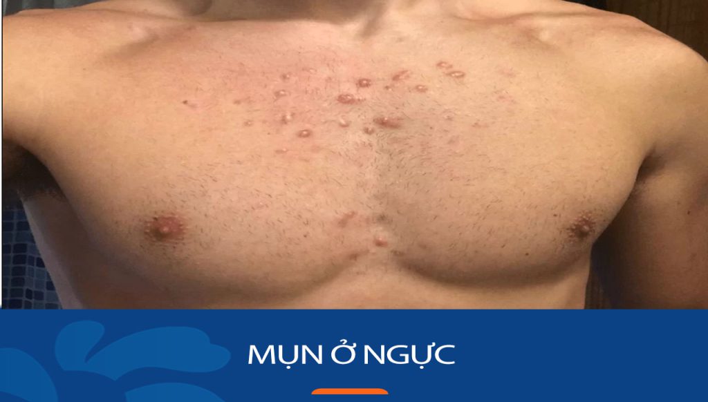 Mụn ở ngực: Bí quyết loại bỏ mụn ở ngực tận gốc