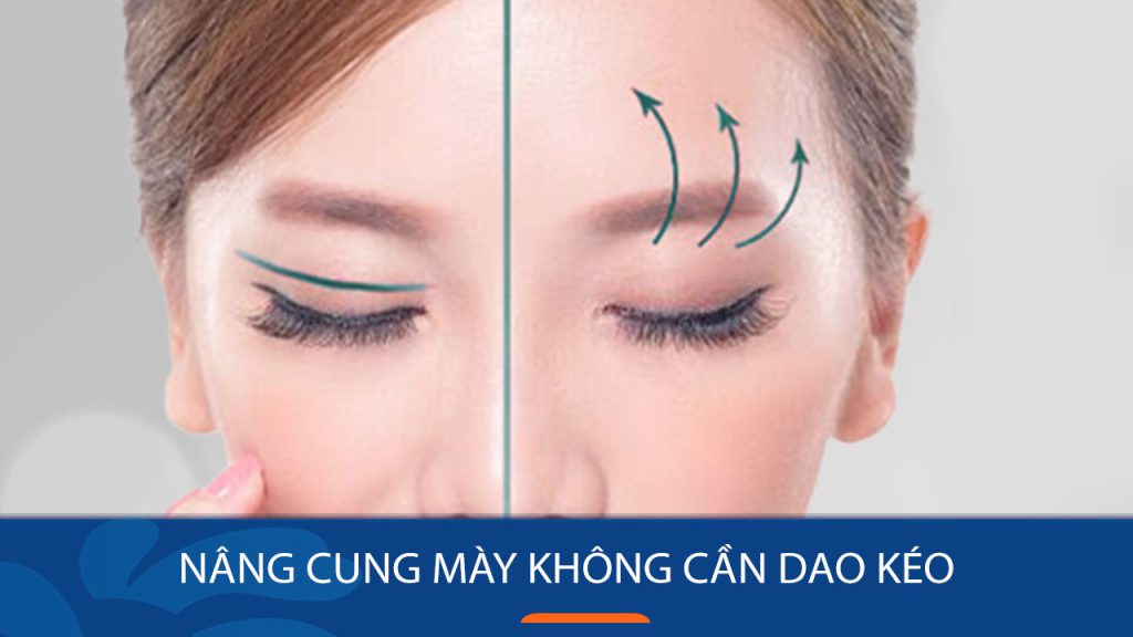Nâng cung mày không cần dao kéo: Bạn đã thử chưa