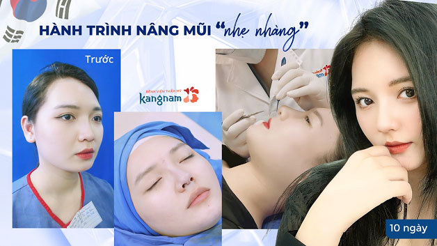 Quá trình biến đổi của khách hàng nâng mũi tại Kangnam