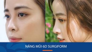 Tìm hiểu về phương pháp nâng mũi 6D Surgiform