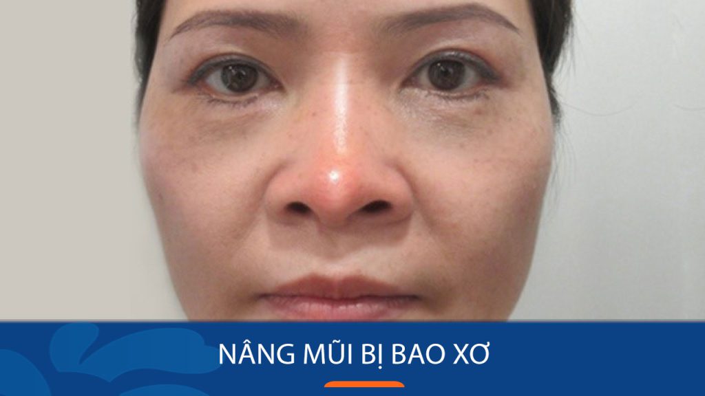 Nâng mũi bị bao xơ: Nguyên nhân, dấu hiệu và cách điều trị an toàn