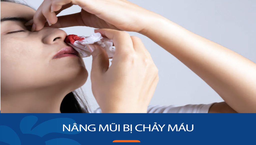 Nâng Mũi Bị Chảy Máu: 3 Nguyên nhân, 3 Cách xử lý nhanh