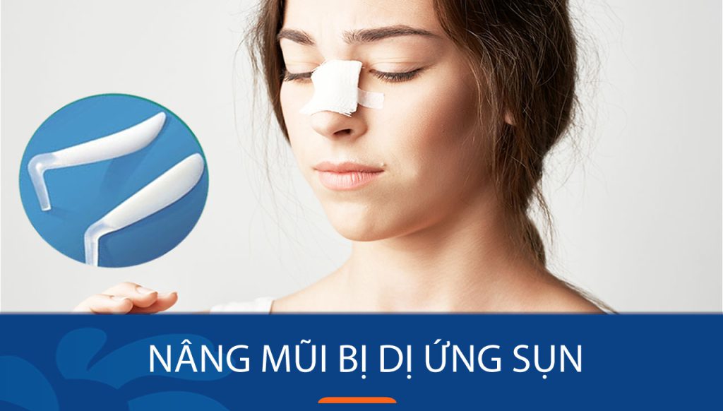Nâng mũi bị dị ứng sụn: Dấu hiệu & Cách khắc phòng tránh