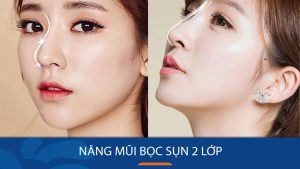 Nâng mũi bọc sụn 2 lớp nhân đôi độ bền, mũi cao tự nhiên