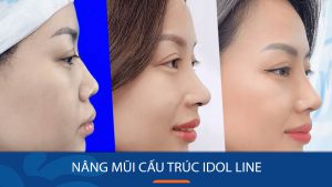 Nâng mũi cấu trúc Idol Line – Mũi siêu nhẹ tướng kiêu kỳ chuẩn Idol 
