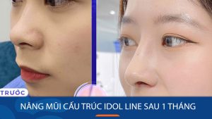 Nâng mũi cấu trúc Idol Line sau 1 tháng: Kết quả, Cách chăm sóc