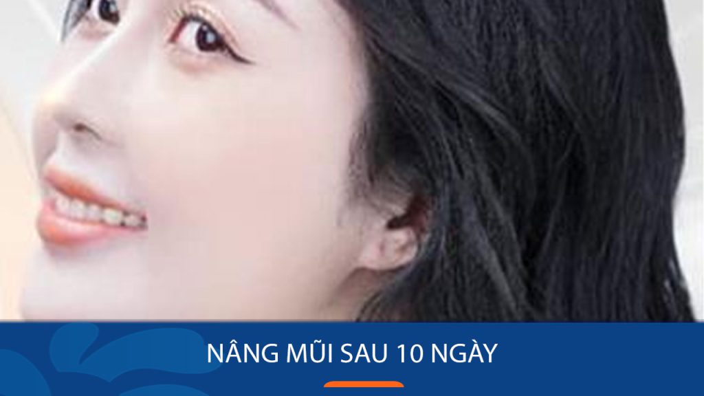 Nâng mũi sau 10 ngày đã đẹp chưa – Kinh nghiệm chăm sóc