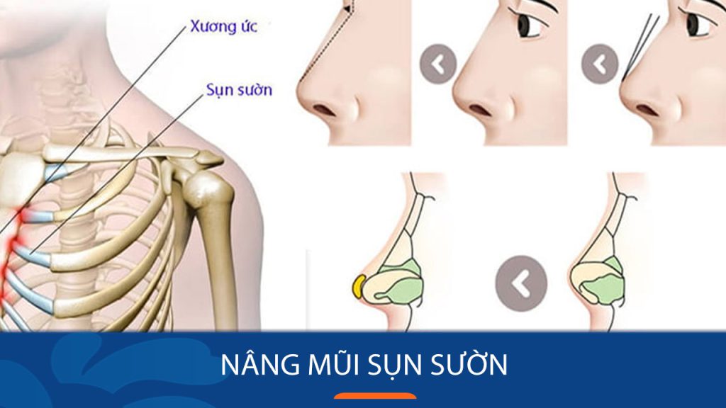 Nâng mũi sườn là gì? Chia sẻ kinh nghiệm từ A đến Z