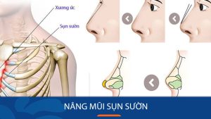 Quy trình phẫu thuật nâng mũi sụn sườn: Từ chuẩn đoán đến phục hồi