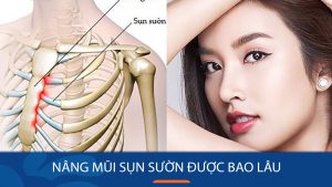 Nâng mũi sụn sườn được bao lâu – Bí quyết duy trì kết quả