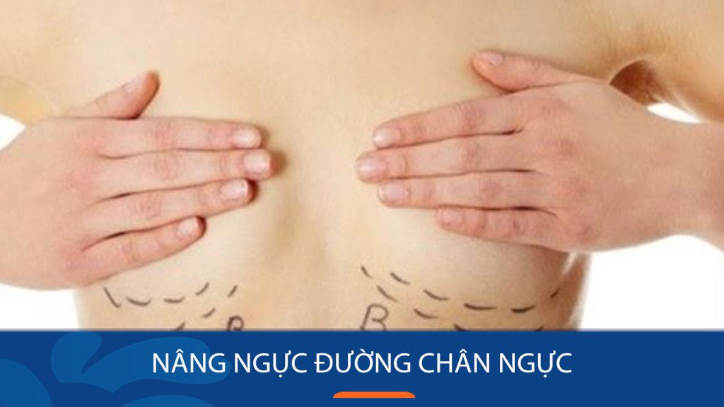 Bác sĩ thẩm mỹ lý giải về phương pháp nâng ngực đường chân ngực
