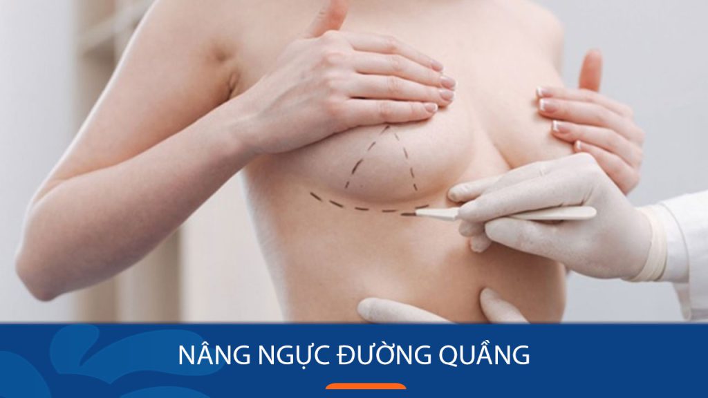 Nâng ngực đường quầng: Bí quyết sở hữu vòng 1 đẹp tự nhiên