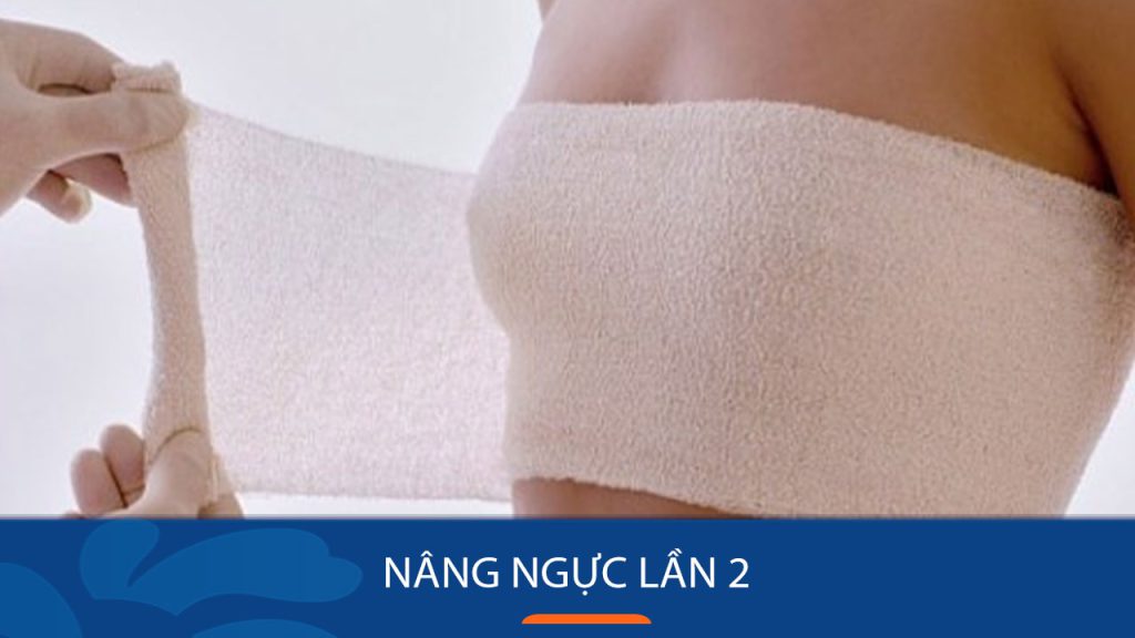 Nâng ngực lần 2: Bí quyết sở hữu vòng 1 hoàn hảo