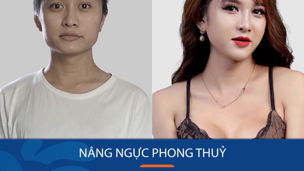 Nâng ngực phong thủy: Giải mã ảnh hưởng đến vận mệnh, tài lộc