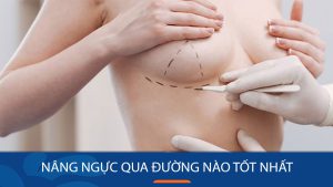 Nâng ngực qua đường nào tốt nhất: Bác sĩ Kangnam giải đáp