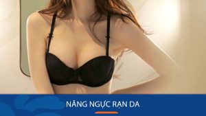 Nâng ngực rạn da không? Cách loại bỏ rạn da sau khi nâng ngực