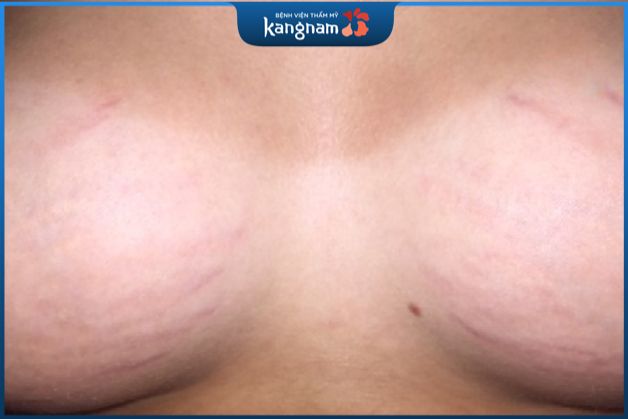 Phẫu thuật nâng ngực rạn da là điều có thể xảy ra