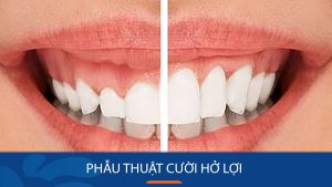 Phẫu thuật cười hở lợi bao lâu thì lành? Lưu ý gì để tránh biến chứng?