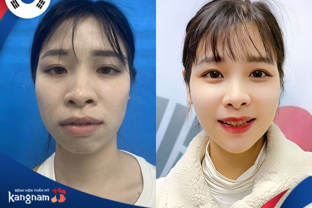 Điều chỉnh hàm hô nhẹ thường được diễn ra trong vòng 120-180