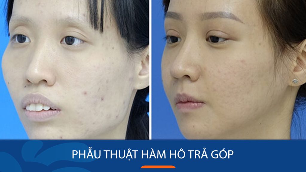 Phẫu thuật hàm hô trả góp 0%- Giải pháp cho nụ cười tự tin, không lo chi phí