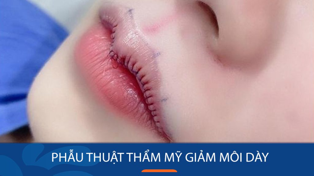 Phẫu thuật môi dày thành mỏng giá bao nhiêu? Chi phí mới nhất
