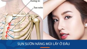 Vị trí lấy sụn sườn tốt nhất cho nâng mũi? Giải đáp từ chuyên gia