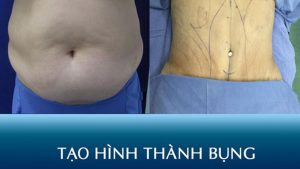 Phẫu thuật tạo hình thành bụng – Giải pháp cho vòng bụng chùng nhão