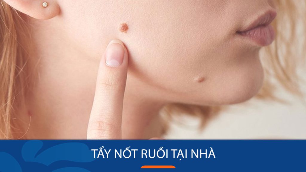 11 Cách Tẩy Nốt Ruồi Tại Nhà Dễ Dàng & Hiệu Quả