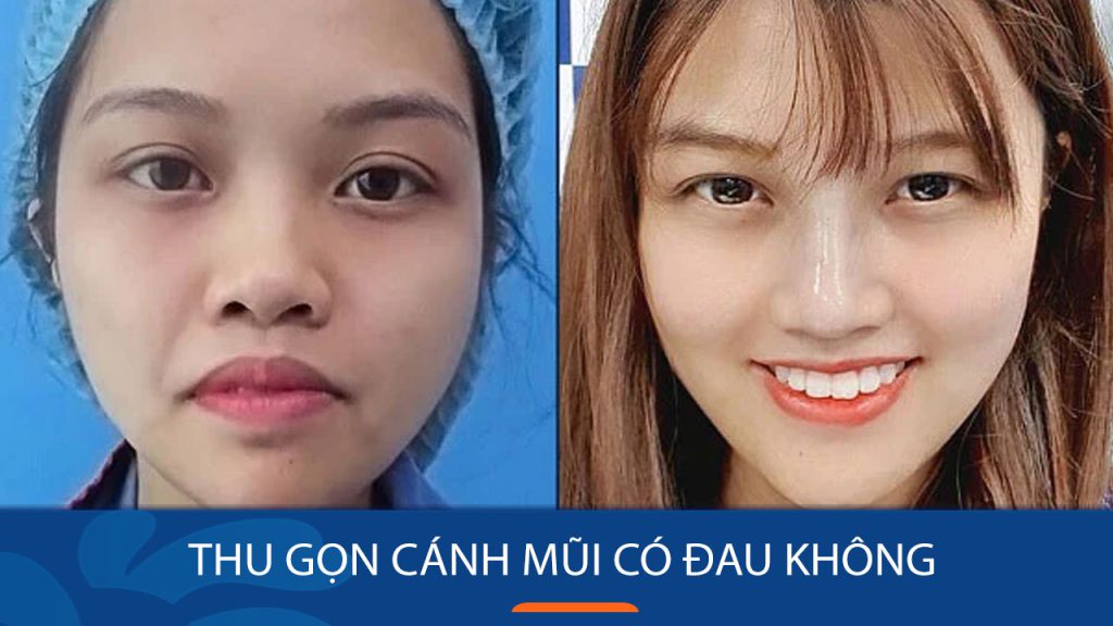 Thu gọn cánh mũi đau không? Giải đáp từ chuyên gia