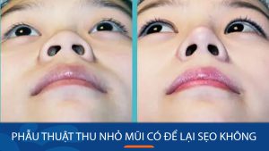 Phẫu thuật thu nhỏ mũi có để lại sẹo không? – Bệnh viện Kangnam