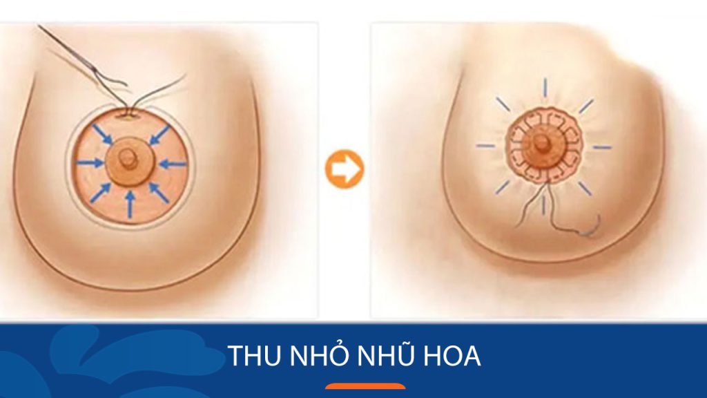 Thẩm mỹ thu nhỏ nhũ hoa: Bí quyết sở hữu vòng 1 hoàn hảo